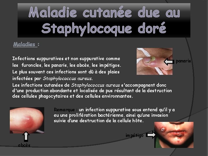 Maladie cutanée due au Staphylocoque doré Maladies : Infections suppuratives et non suppurative comme