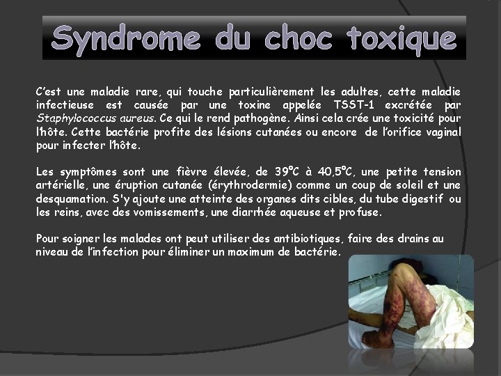 Syndrome du choc toxique C’est une maladie rare, qui touche particulièrement les adultes, cette