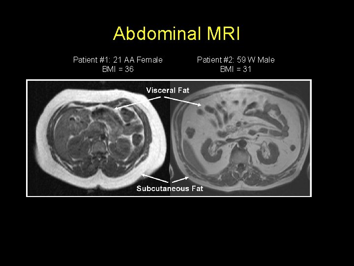 Abdominal MRI Patient #1: 21 AA Female BMI = 36 Patient #2: 59 W