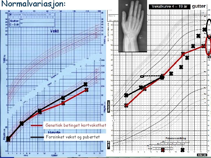 Normalvariasjon: Genetisk betinget kortvoksthet Forsinket vekst og pubertet 21 