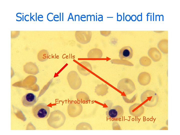 Sickle Cell Anemia – blood film Sickle Cells Erythroblasts Howell-Jolly Body 