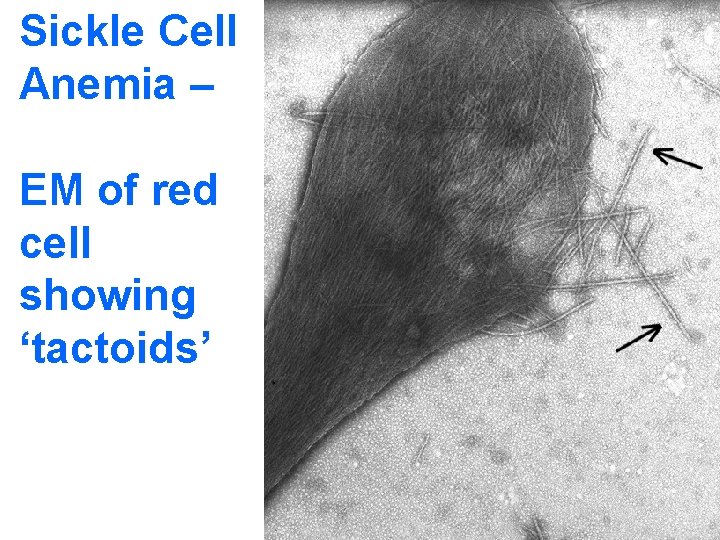Sickle Cell Anemia – EM of red cell showing ‘tactoids’ 