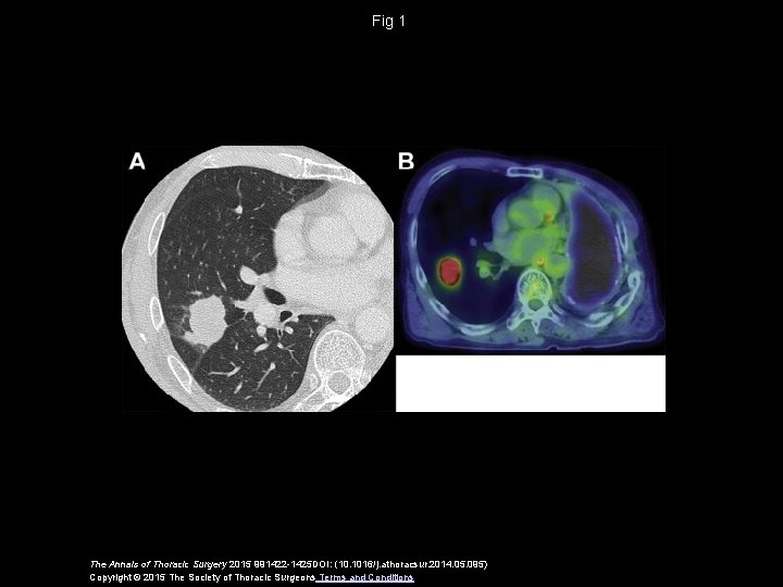 Fig 1 The Annals of Thoracic Surgery 2015 991422 -1425 DOI: (10. 1016/j. athoracsur.