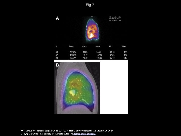 Fig 2 The Annals of Thoracic Surgery 2015 991422 -1425 DOI: (10. 1016/j. athoracsur.