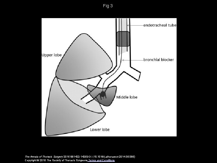 Fig 3 The Annals of Thoracic Surgery 2015 991422 -1425 DOI: (10. 1016/j. athoracsur.