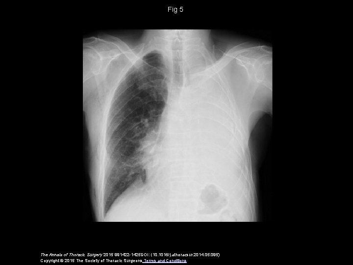 Fig 5 The Annals of Thoracic Surgery 2015 991422 -1425 DOI: (10. 1016/j. athoracsur.