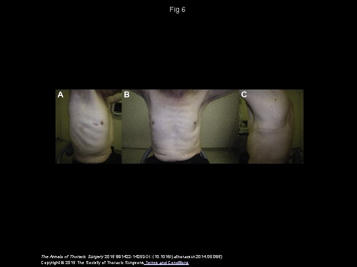Fig 6 The Annals of Thoracic Surgery 2015 991422 -1425 DOI: (10. 1016/j. athoracsur.