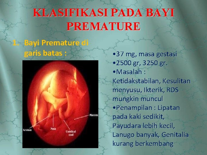 KLASIFIKASI PADA BAYI PREMATURE 1. Bayi Premature di garis batas : • 37 mg,