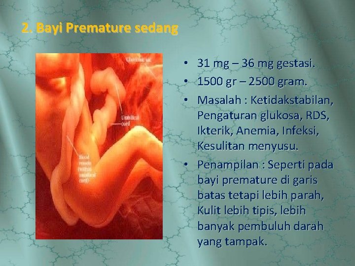 2. Bayi Premature sedang 31 mg – 36 mg gestasi. 1500 gr – 2500