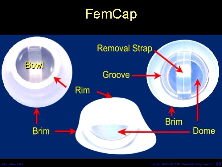 Fem. Cap Anita L. Nelson, MD Barrier Methods 2013 Contemporary Forums 23 