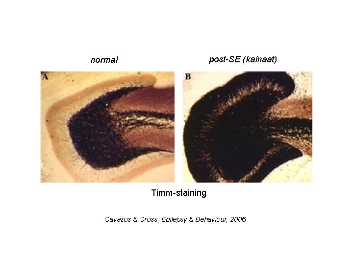 post-SE (kainaat) normal Timm-staining Cavazos & Cross, Epilepsy & Behaviour, 2006 