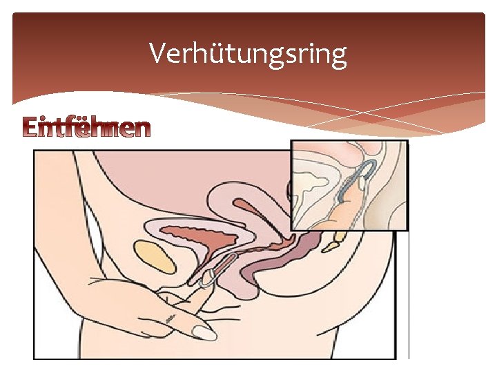 Verhütungsring Der Ring verhindert mit Hormonen den Eisprung. Der Ring ist aus Kunststoff. Er