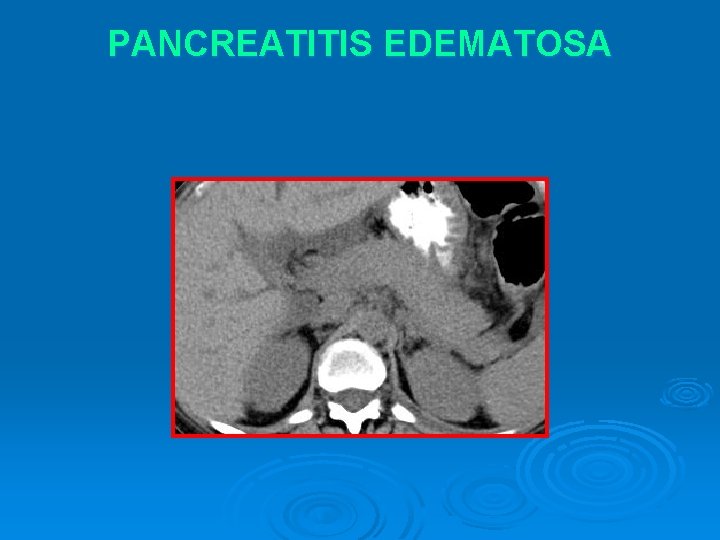 PANCREATITIS EDEMATOSA 