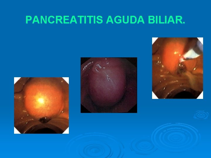 PANCREATITIS AGUDA BILIAR. 