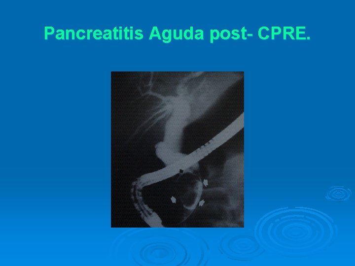 Pancreatitis Aguda post- CPRE. 