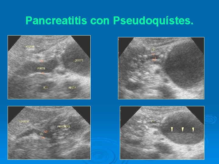 Pancreatitis con Pseudoquístes. 