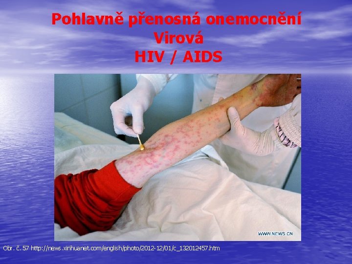 Pohlavně přenosná onemocnění Virová HIV / AIDS Obr. č. 57 http: //news. xinhuanet. com/english/photo/2012