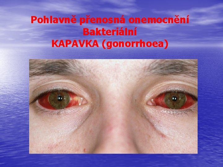 Pohlavně přenosná onemocnění Bakteriální KAPAVKA (gonorrhoea) 