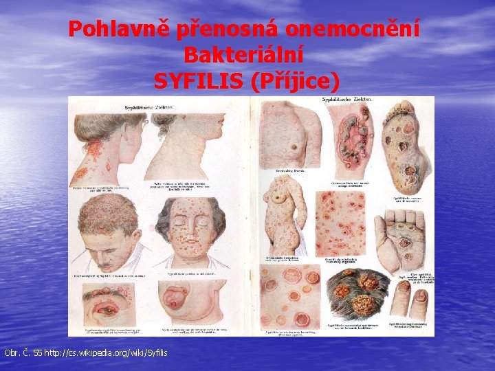 Pohlavně přenosná onemocnění Bakteriální SYFILIS (Příjice) Obr. Č. 55 http: //cs. wikipedia. org/wiki/Syfilis 