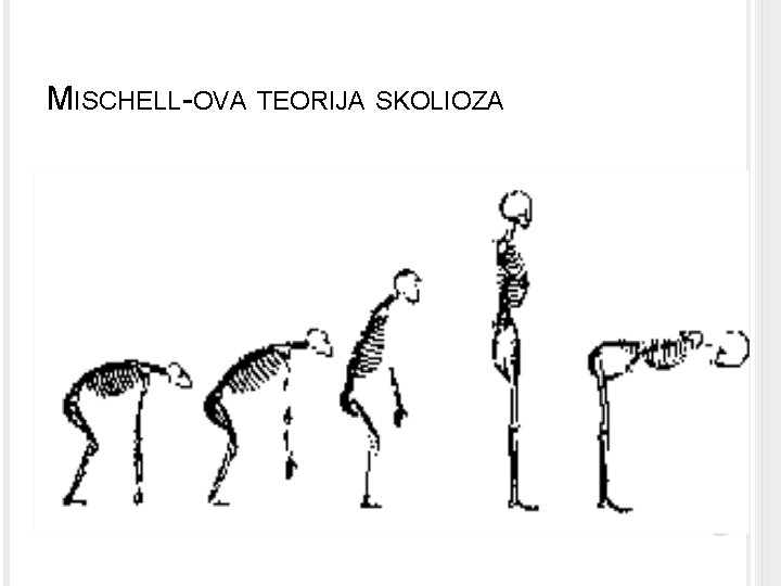 MISCHELL-OVA TEORIJA SKOLIOZA 