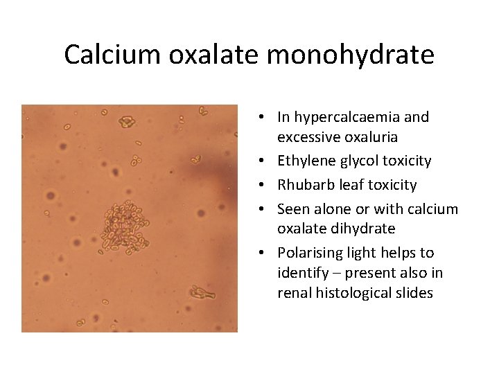 Calcium oxalate monohydrate • In hypercalcaemia and excessive oxaluria • Ethylene glycol toxicity •