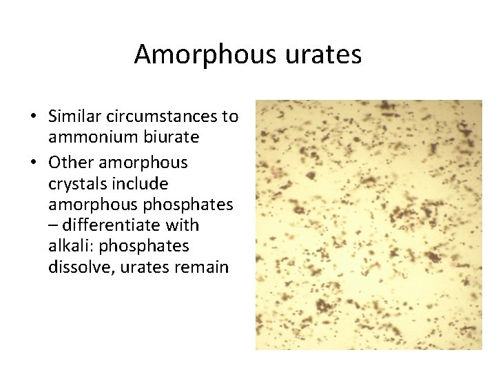 Amorphous urates • Similar circumstances to ammonium biurate • Other amorphous crystals include amorphous