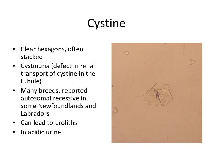 Cystine • Clear hexagons, often stacked • Cystinuria (defect in renal transport of cystine