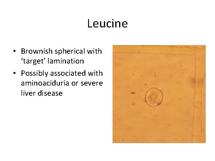 Leucine • Brownish spherical with ‘target’ lamination • Possibly associated with aminoaciduria or severe
