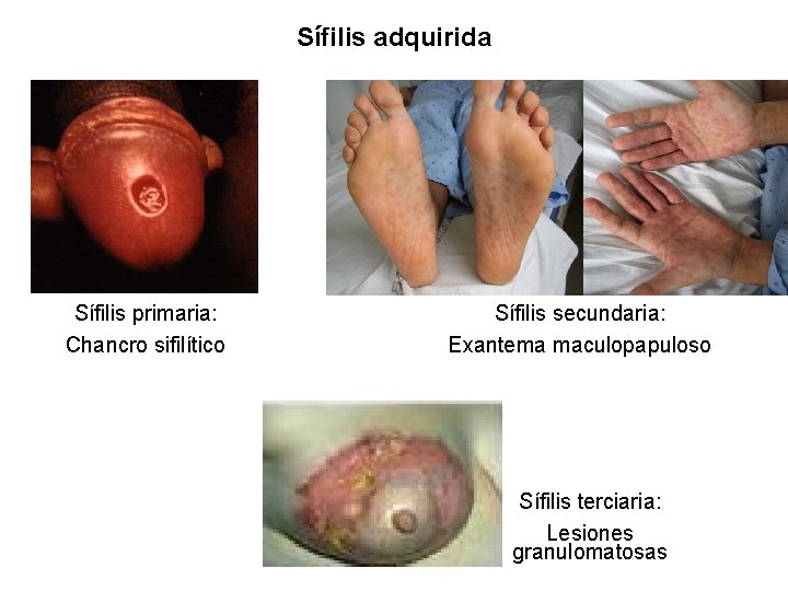 Sífilis adquirida Sífilis primaria: Chancro sifilítico Sífilis secundaria: Exantema maculopapuloso Sífilis terciaria: Lesiones granulomatosas
