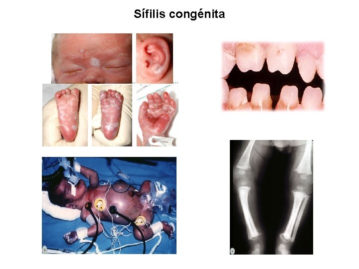 Sífilis congénita 