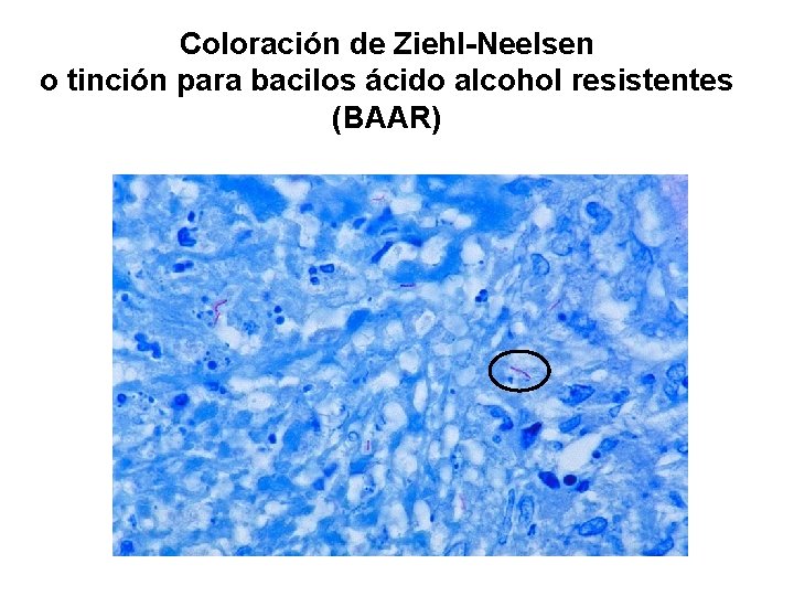 Coloración de Ziehl-Neelsen o tinción para bacilos ácido alcohol resistentes (BAAR) 