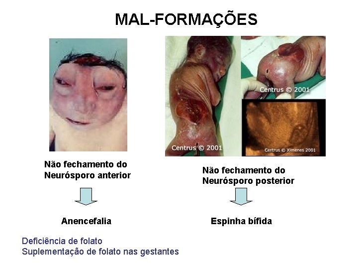 MAL-FORMAÇÕES Não fechamento do Neurósporo anterior Anencefalia Deficiência de folato Suplementação de folato nas