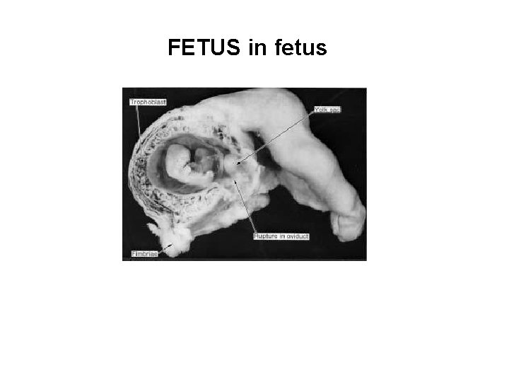 FETUS in fetus 