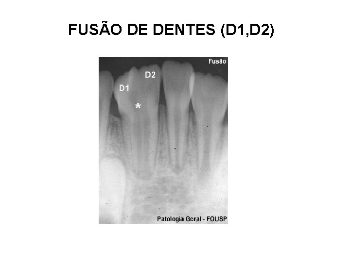 FUSÃO DE DENTES (D 1, D 2) 