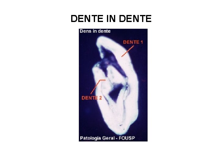 DENTE IN DENTE 