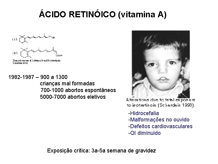 ÁCIDO RETINÓICO (vitamina A) 1982 -1987 – 900 a 1300 crianças mal formadas 700