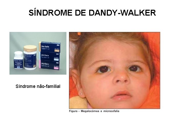 SÍNDROME DE DANDY-WALKER Síndrome não-familial 