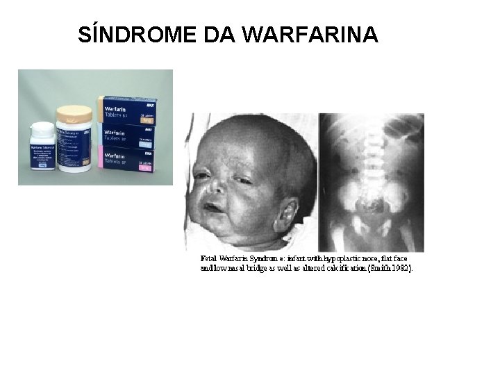 SÍNDROME DA WARFARINA 