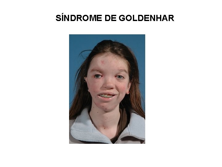 SÍNDROME DE GOLDENHAR 