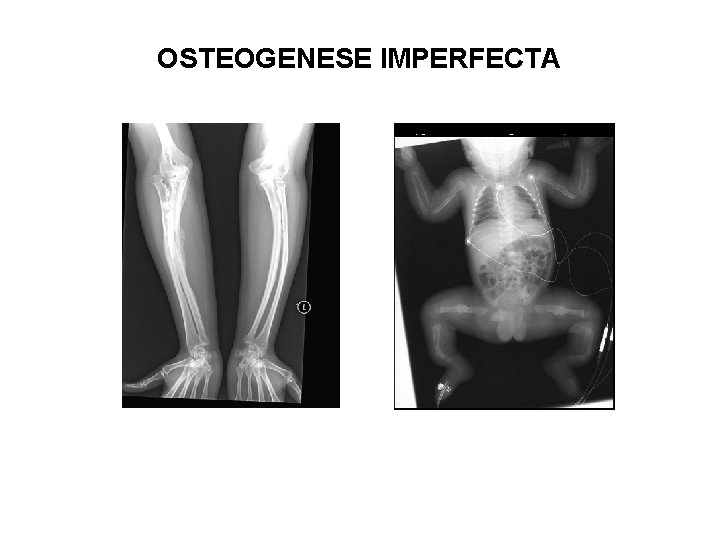 OSTEOGENESE IMPERFECTA 