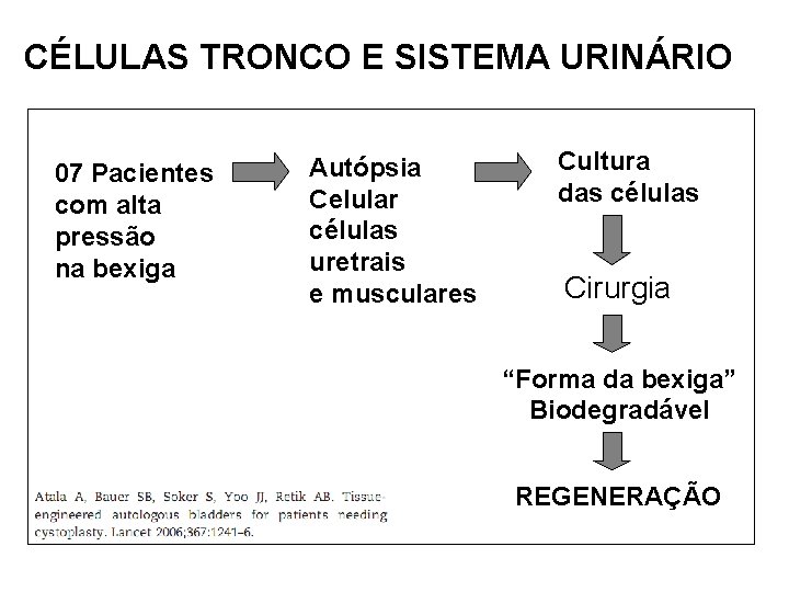 CÉLULAS TRONCO E SISTEMA URINÁRIO 07 Pacientes com alta pressão na bexiga Autópsia Celular