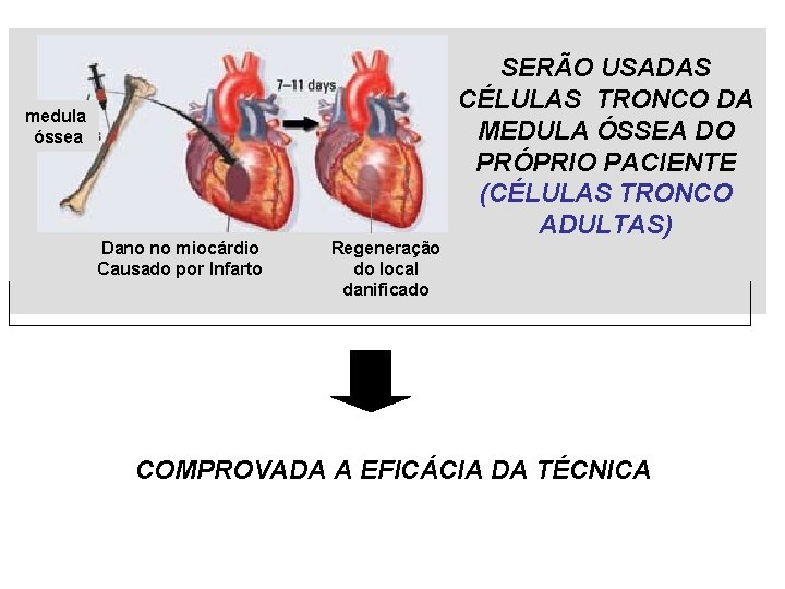 medula óssea Dano no miocárdio Causado por Infarto Regeneração do local danificado SERÃO USADAS