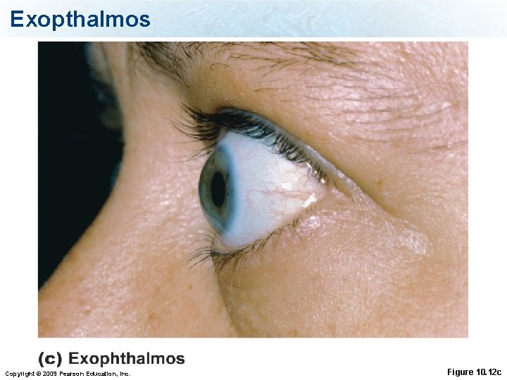 Exopthalmos Copyright © 2009 Pearson Education, Inc. Figure 10. 12 c 