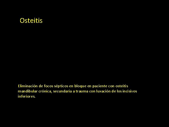Osteitis Eliminación de focos sépticos en bloque en paciente con osteitis mandibular crónica, secundaria