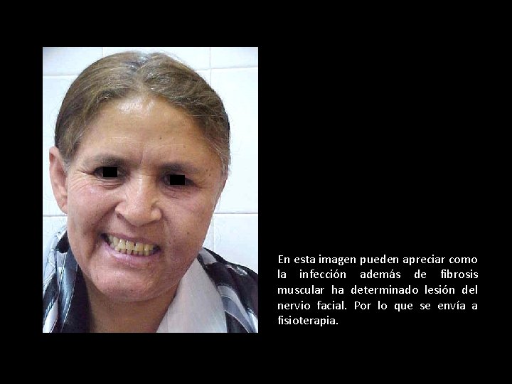 En esta imagen pueden apreciar como la infección además de fibrosis muscular ha determinado
