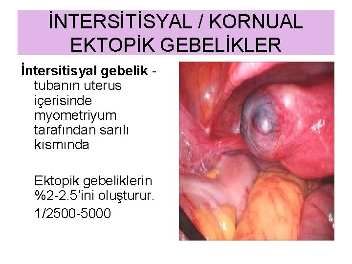İNTERSİTİSYAL / KORNUAL EKTOPİK GEBELİKLER İntersitisyal gebelik tubanın uterus içerisinde myometriyum tarafından sarılı kısmında