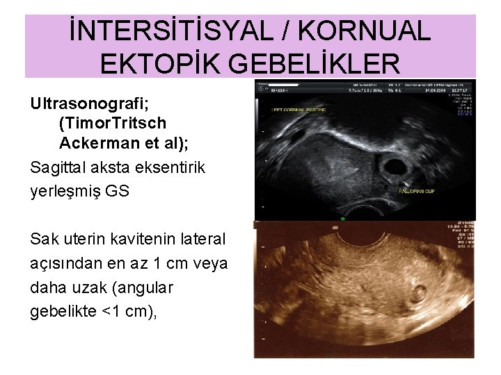 İNTERSİTİSYAL / KORNUAL EKTOPİK GEBELİKLER Ultrasonografi; (Timor. Tritsch Ackerman et al); Sagittal aksta eksentirik