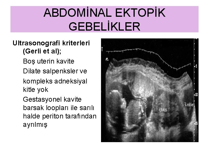 ABDOMİNAL EKTOPİK GEBELİKLER Ultrasonografi kriterleri (Gerli et al); Boş uterin kavite Dilate salpenksler ve