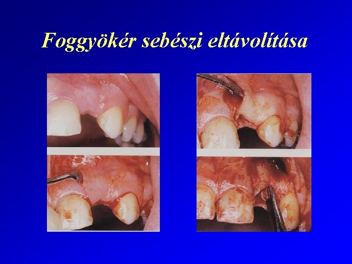 Foggyökér sebészi eltávolítása 