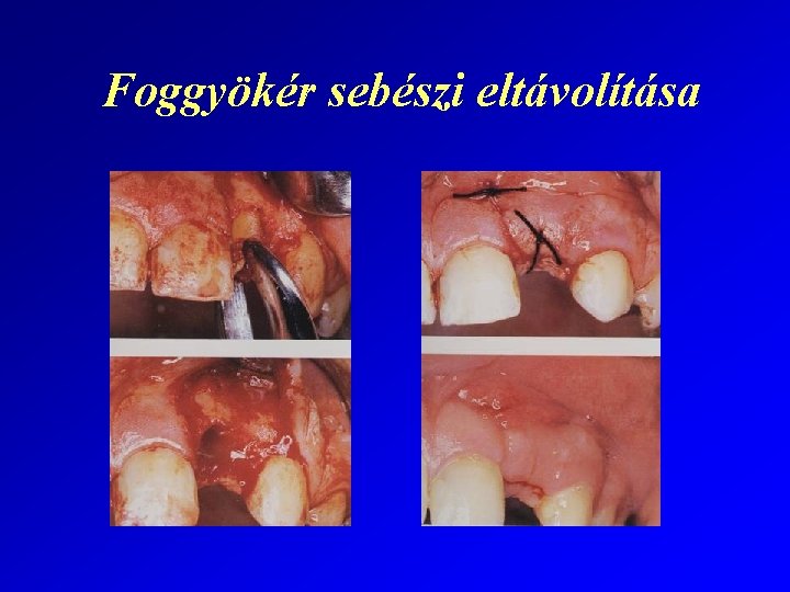 Foggyökér sebészi eltávolítása 